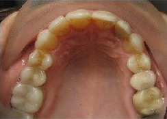 Invisalign Treatment after 346613