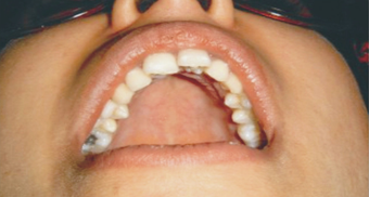 The Hollywood smile with Invisalign before 293409