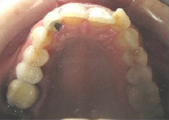 Invisalign Treatment before 346613