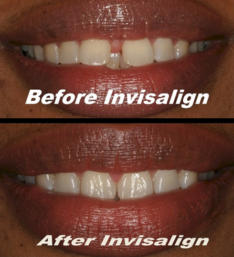 Invisalign before 75406