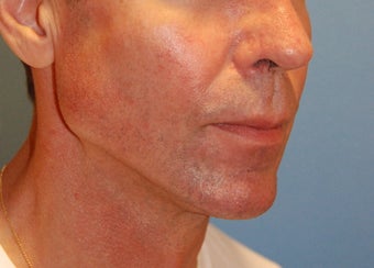 Jaw Augmentation w/ Mandibular Implants after 166195
