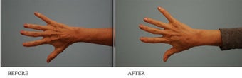 Juvederm to hands after 458715