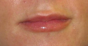 Juvederm after 53635