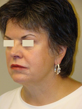 Juvederm Injections for midface before 103876