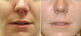 Juvederm before 273766