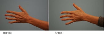 Juvederm to hands before 458715