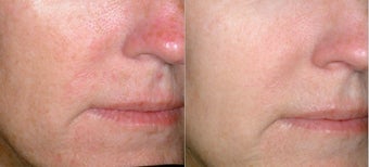 Photorejuvenation