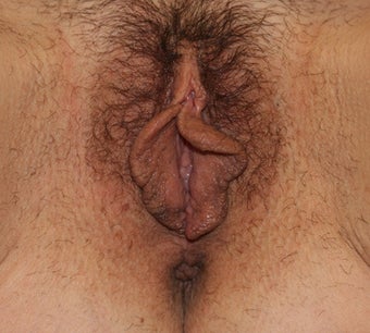 Vaginoplasty before 261005