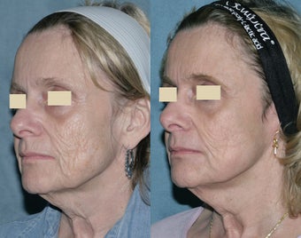 Fraxel repair with C02/Erbium lasers for upper lip wrinkles before 104306