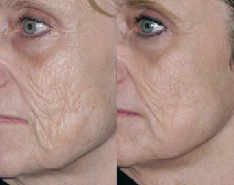 Fraxel repair with C02/Erbium lasers for upper lip wrinkles before 104311