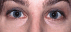 Laser Resurfacing with Erbium laser after 154204