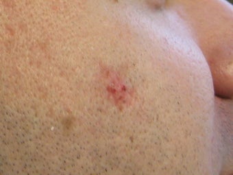 Acne scars treated with Punch Elevation of scars and Fractional Laser Resurfacing after 272104