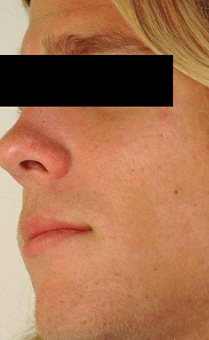Laser Resurfacing for Enlarged Pores after 89100