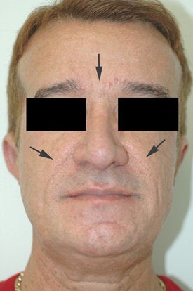 Botox and Restylane Treatment after 91064