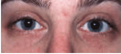 Laser Resurfacing with Erbium laser before 154204