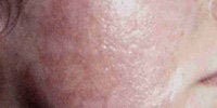 Acne Scars with Laser Resurfacing before 272024