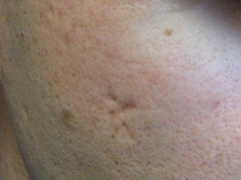 Acne scars treated with Punch Elevation of scars and Fractional Laser Resurfacing before 272104