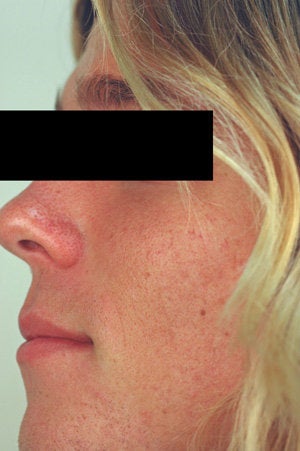 Laser Resurfacing for Enlarged Pores before 89100