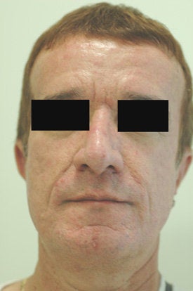 Botox and Restylane Treatment before 91064