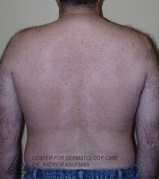Laser Hair Removal after 315165