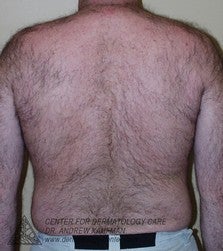 Laser Hair Removal before 315165