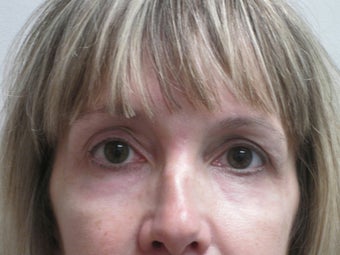 Peri Orbital Laser Resurfacing after 323577