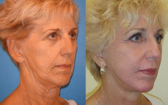 Image Lift, Full Face Laser after 351059