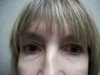 Peri Orbital Laser Resurfacing before 323577