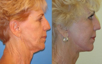 Image Lift, Full Face Laser before 351059