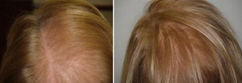 Low Lever Laser Light Therapy after 358811