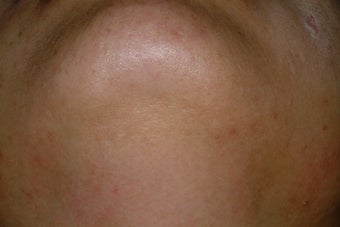 Chin folliculitis and LHR