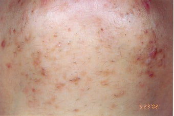 Chin folliculitis and LHR