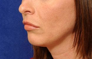 Before and After Lip Augmentation after 66154