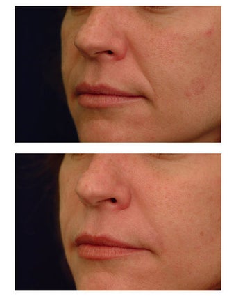 Injectable Filler before 301187