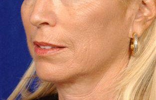 Beforeand After Lip Augmentation before 66152