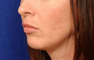 Before and After Lip Augmentation before 66154