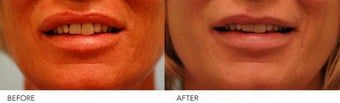 Lip reduction after 254539