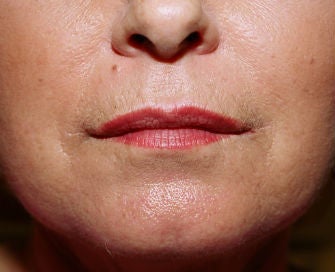 Anguloplasty after 299917