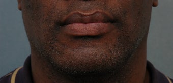 Cheiloplasty