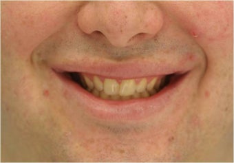Lip Surgery, Lip Reduction after 458986