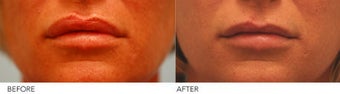 Lip reduction before 254539