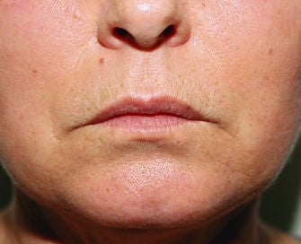 Anguloplasty before 299917