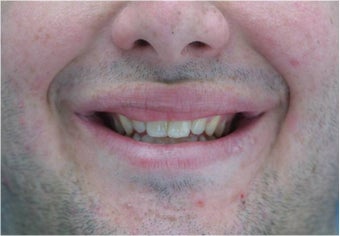 Lip Surgery, Lip Reduction before 458986
