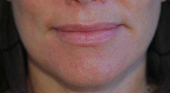 Lip Augmentation after 399260