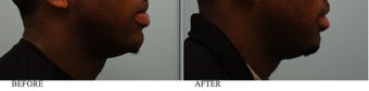 African American Lip Reduction after 445515