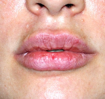 Lip Augmentation after 544862
