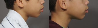 Lip Reduction before 323957