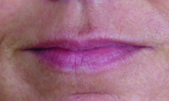 Restylane Injection before 324367