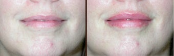 Lip augmentation before 506295