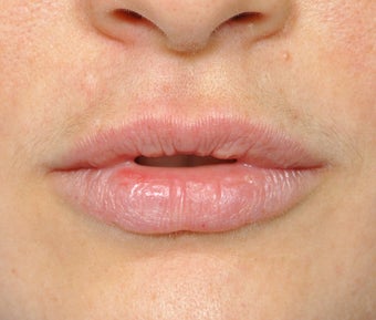 Lip Augmentation before 544862